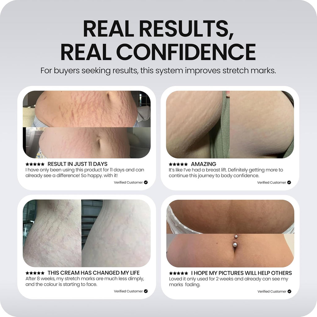 Stretch Mark Repair Programme | 12-Week Kit with Microneedling Tool, Cellular Repair Serum & Redefining Stretch Mark Cream | Clinically Proven to Restore Collagen & Reduce Stretch Marks