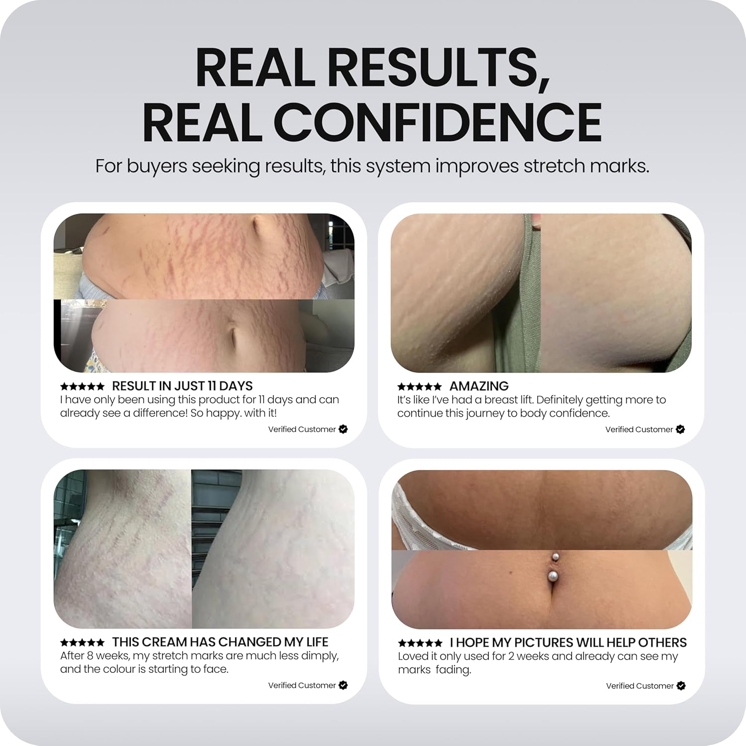 Stretch Mark Repair Programme | 12-Week Kit with Microneedling Tool, Cellular Repair Serum & Redefining Stretch Mark Cream | Clinically Proven to Restore Collagen & Reduce Stretch Marks